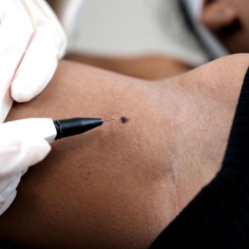 Skin Tag Removal