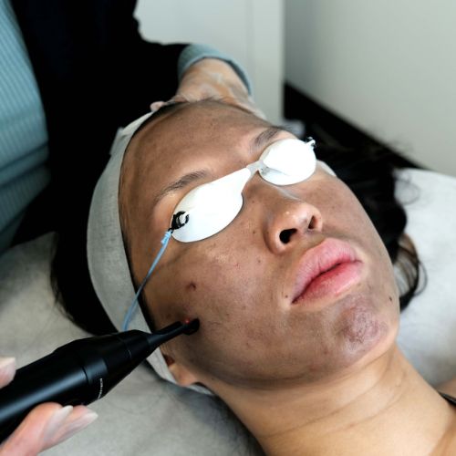 Carbon Peel Facial