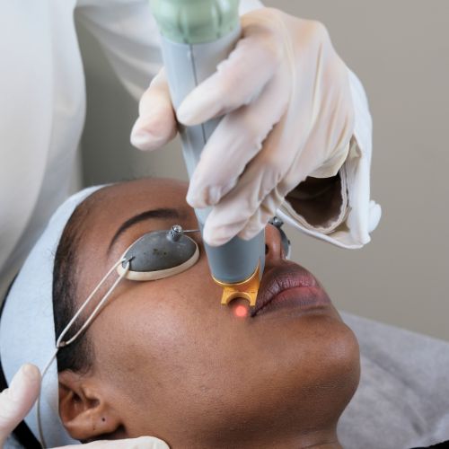Laser Facial Hair Removal