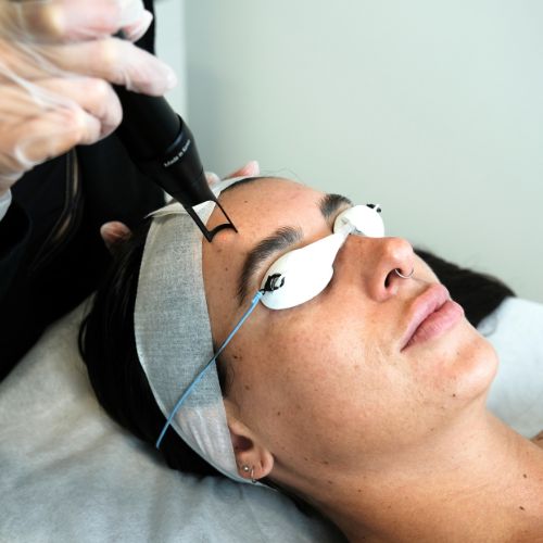 Laser Rejuvenation
