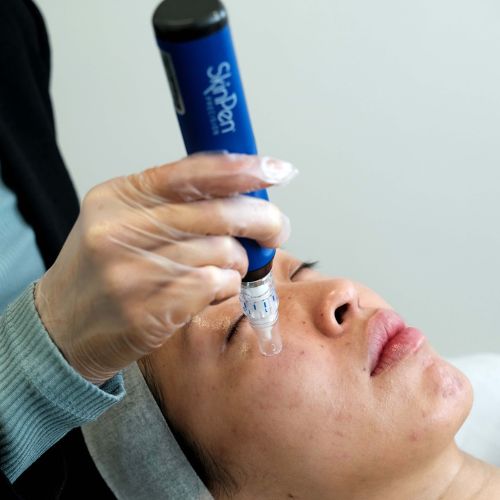 Micro Needling