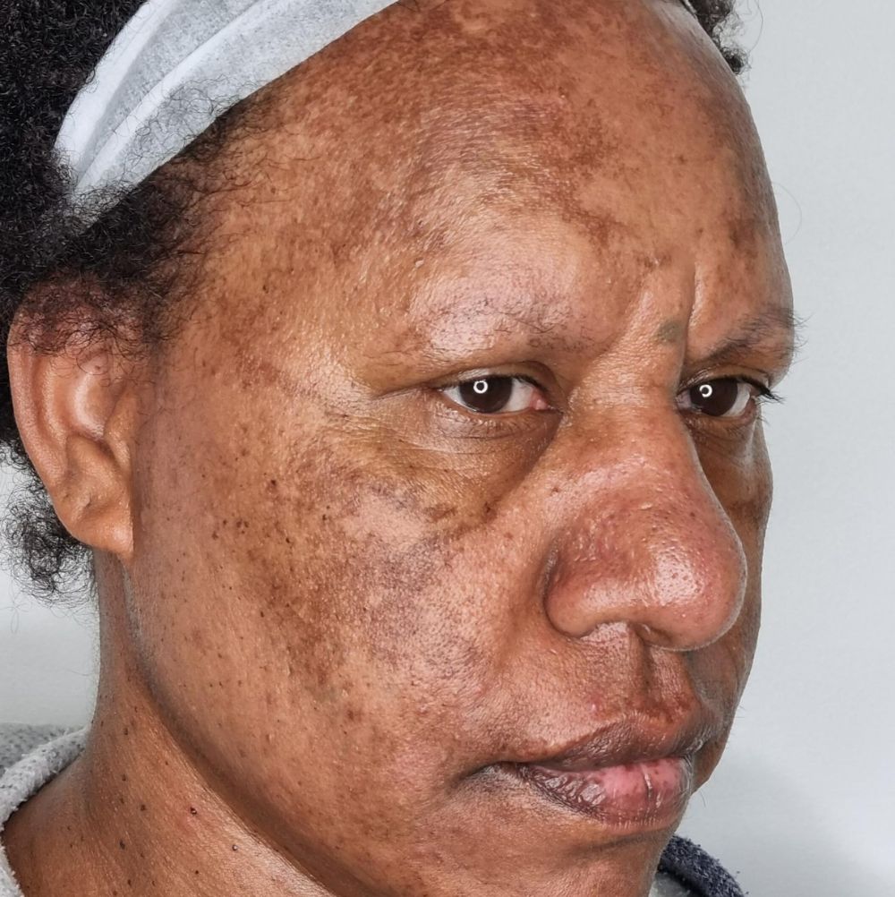 skin pigmentation treatment